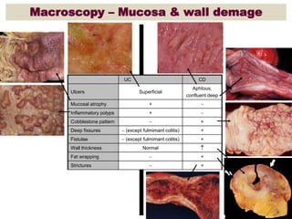 Macroscopy – Mucosa & wall demage
CDUC
Aphtous,
confluent deep
SuperficialUlcers
+Mucosal atrophy
+Inflammatory polyps
+Cobblestone pattern
+ (except fulmimant colitis)Deep fissures
+ (except fulmimant colitis)Fistulae
NormalWall thickness
+Fat wrapping
+Strictures
 
