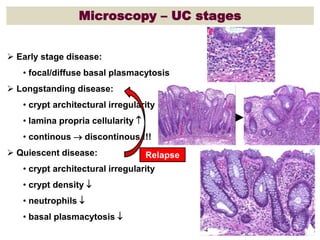 Microscopy – UC stages
 Early stage disease:
• focal/diffuse basal plasmacytosis
 Longstanding disease:
• crypt architectural irregularity
• lamina propria cellularity 
• continous  discontinous !!!
 Quiescent disease:
• crypt architectural irregularity
• crypt density 
• neutrophils 
• basal plasmacytosis 
Relapse
 