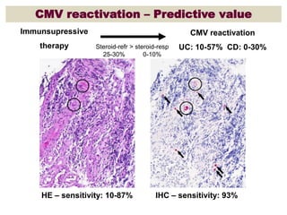 CMV reactivation – Predictive value
Immunsupressive
therapy
CMV reactivation
UC: 10-57% CD: 0-30%Steroid-refr > steroid-resp
25-30% 0-10%
HE – sensitivity: 10-87% IHC – sensitivity: 93%
 
