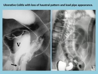 Haustral Activity Inflammatory Bowel Disease (IBD) Explanation | PPTX