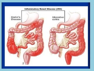 Inflammatory Bowel Disease (IBD) Explanation | PPTX