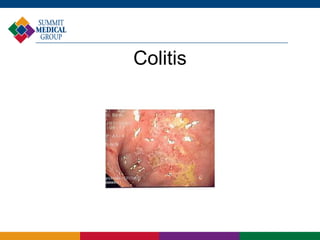 Colitis
 