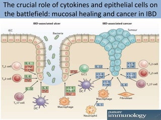 The crucial role of cytokines and epithelial cells on
the battlefield: mucosal healing and cancer in IBD
 