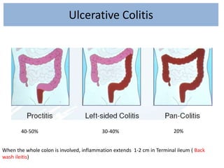 Ulcerative Colitis
When the whole colon is involved, inflammation extends 1-2 cm in Terminal ileum ( Back
wash ileitis)
40-50% 30-40% 20%
 