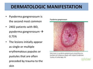 DERMATOLOGIC MANIFESTATION
• Pyoderma gangrenosum is
the second most common
• 2402 patients with IBD,
pyoderma gangrenosum 
0.75%
• The lesions initially appear
as single or multiple
erythematous papules or
pustules that are often
preceded by trauma to the
skin
 