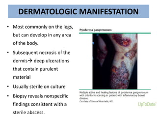 DERMATOLOGIC MANIFESTATION
• Most commonly on the legs,
but can develop in any area
of the body.
• Subsequent necrosis of the
dermis deep ulcerations
that contain purulent
material
• Usually sterile on culture
• Biopsy reveals nonspecific
findings consistent with a
sterile abscess.
 