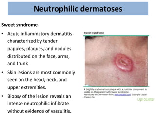 Neutrophilic dermatoses
Sweet syndrome
• Acute inflammatory dermatitis
characterized by tender
papules, plaques, and nodules
distributed on the face, arms,
and trunk
• Skin lesions are most commonly
seen on the head, neck, and
upper extremities.
• Biopsy of the lesion reveals an
intense neutrophilic infiltrate
without evidence of vasculitis.
 
