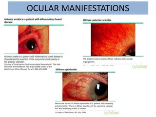 OCULAR MANIFESTATIONS
 
