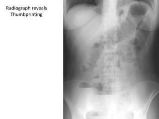 Radiograph reveals
Thumbprinting
 