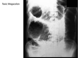 Toxic Megacolon
 