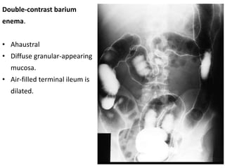 Double-contrast barium
enema.
• Ahaustral
• Diffuse granular-appearing
mucosa.
• Air-filled terminal ileum is
dilated.
 
