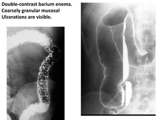 Double-contrast barium enema.
Coarsely granular mucosal
Ulcerations are visible.
 