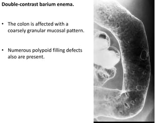 Double-contrast barium enema.
• The colon is affected with a
coarsely granular mucosal pattern.
• Numerous polypoid filling defects
also are present.
 