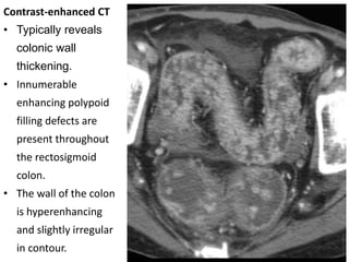 Contrast-enhanced CT
• Typically reveals
colonic wall
thickening.
• Innumerable
enhancing polypoid
filling defects are
present throughout
the rectosigmoid
colon.
• The wall of the colon
is hyperenhancing
and slightly irregular
in contour.
 
