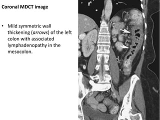 Coronal MDCT image
• Mild symmetric wall
thickening (arrows) of the left
colon with associated
lymphadenopathy in the
mesocolon.
 
