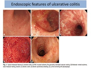 Endoscopic features of ulcerative colitis
 