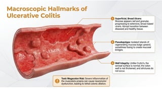Inflammatory Bowel Disease (IBD): Crohn’s Disease and Ulcerative ...