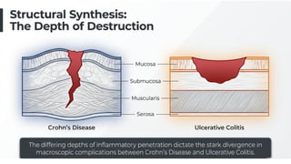 Inflammatory Bowel Disease (IBD): Crohn’s Disease and Ulcerative ...