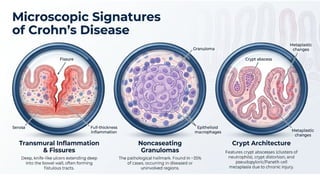 Inflammatory Bowel Disease (IBD): Crohn’s Disease and Ulcerative ...