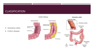 CLASSIFICATION
 Ulcerative colitis
 Crohn’s disease
 