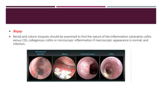  Biopsy
 Rectal and colonic biopsies should be examined to find the nature of the inflammation (ulcerative colitis
versus CD), collagenous colitis or microscopic inflammation if macroscopic appearance is normal, and
infection.
 