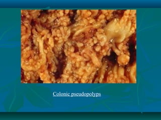 Colonic pseudopolyps

 