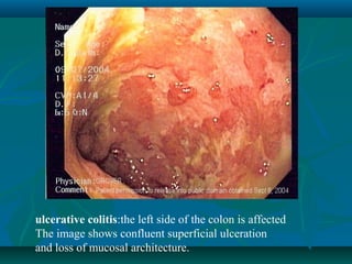 ulcerative colitis:the left side of the colon is affected
The image shows confluent superficial ulceration
and loss of mucosal architecture.

 