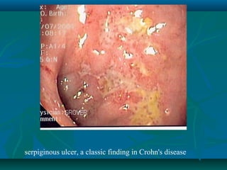 serpiginous ulcer, a classic finding in Crohn's disease

 