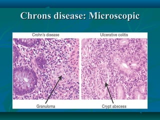 Chrons disease: Microscopic

 