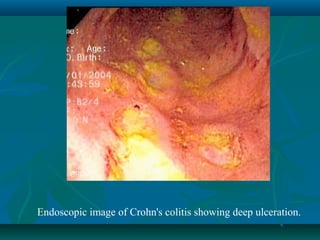Endoscopic image of Crohn's colitis showing deep ulceration.

 