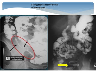 INFLAMMATORY BOWEL DISEASE IMAGING(RADIOLOGY) | PPTX
