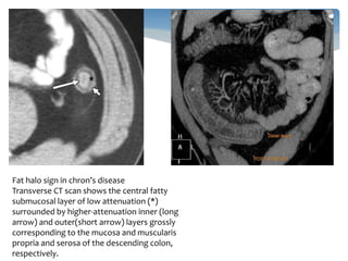 inflammatory-bowel-disease-imaging-radiology-pptx