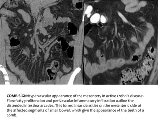 INFLAMMATORY BOWEL DISEASE IMAGING(RADIOLOGY) | PPTX