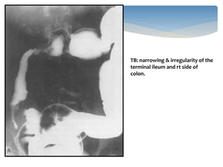 INFLAMMATORY BOWEL DISEASE IMAGING(RADIOLOGY) | PPTX