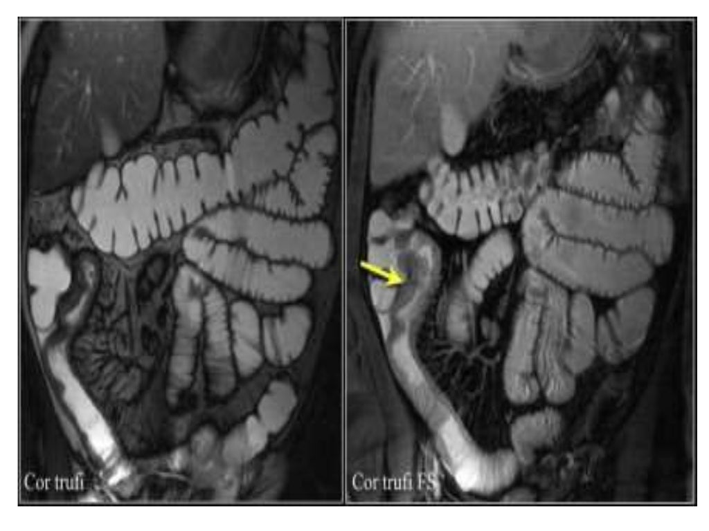 INFLAMMATORY BOWEL DISEASE IMAGING(RADIOLOGY)