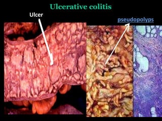 Ulcerative colitis
Ulcer
pseudopolyps
 