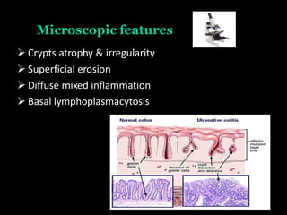 Microscopic features
 Crypts atrophy & irregularity
 Superficial erosion
 Diffuse mixed inflammation
 Basal lymphoplasmacytosis
 