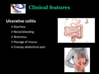Clinical features
Ulcerative colitis
Diarrhea
Rectal bleeding
Tenesmus
Passage of mucus
Crampy abdominal pain
 
