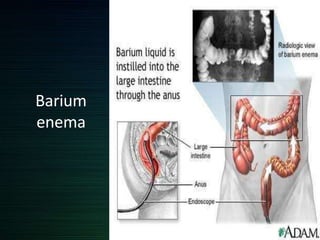 Barium
enema
 