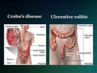 Ulcerative colitisCrohn’s disease
 