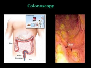 Colonoscopy
 