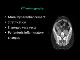 CT enterography
• Mural hyperenhancement
• Stratification
• Engorged vasa recta
• Perienteric inflammatory
changes
 