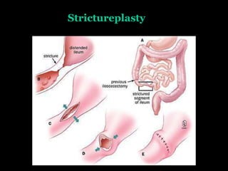Strictureplasty
 
