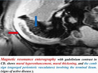 Magnetic resonance enterography with gadolinium contrast in
CD. shows mural hyperenhancement, mural thickening, and the comb
sign (engorged perienteric vasculature) involving the terminal ileum.
(signs of active disease ).
 