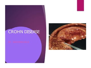 CROHN DISEASE
BY : SADINAKHALA
 