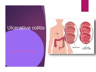 Ulcerative colitis
By :Khaled H.Alkhodari
 