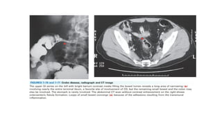 IBD PRESENTATION INCLUDING CROHNS AND ULCERATIVE COLITIS.pptx