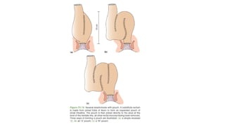 IBD PRESENTATION INCLUDING CROHNS AND ULCERATIVE COLITIS.pptx