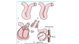 IBD PRESENTATION INCLUDING CROHNS AND ULCERATIVE COLITIS.pptx