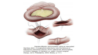 IBD PRESENTATION INCLUDING CROHNS AND ULCERATIVE COLITIS.pptx